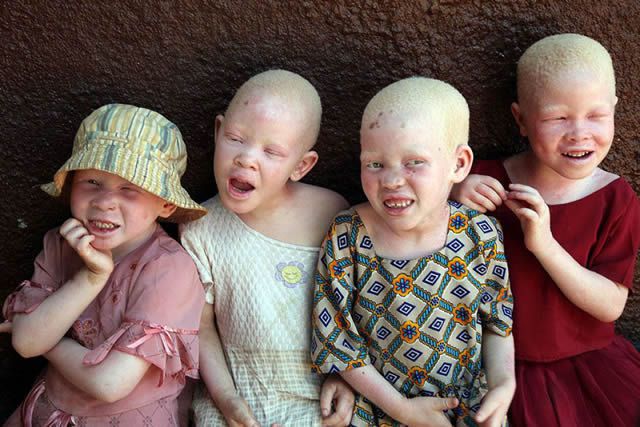 The international attention in favor of people with Albinism in Africa